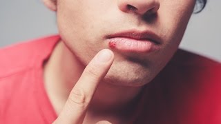 Dermatologist explains causes of cold sores [upl. by Chuipek819]