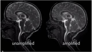 Types of Chiari Malformation [upl. by Adnamor]