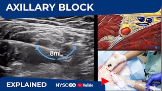 Ultrasound Guided Axillary Brachial Plexus Block NYSORA Regional Anesthesia [upl. by Adachi]