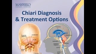 ArnoldChiari 1 Malformation [upl. by Ahsiuqet308]